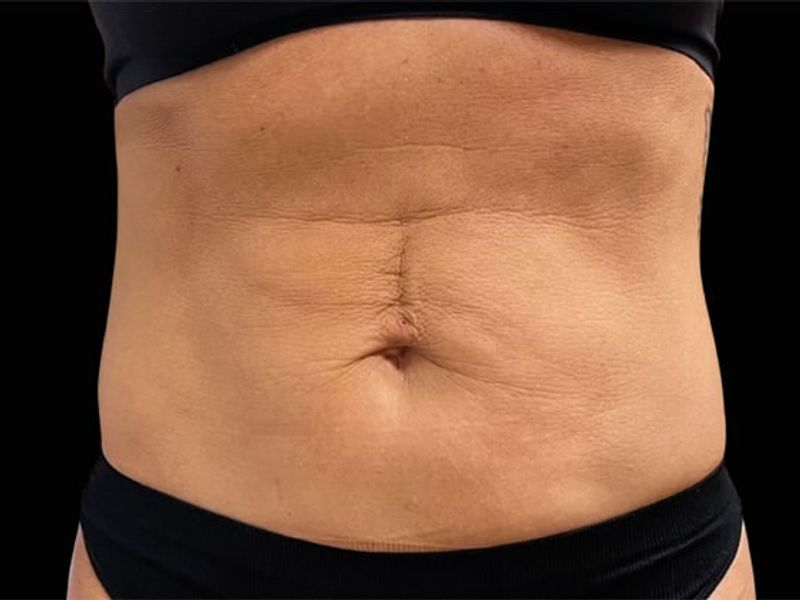 Mature woman abs Before Emsculpt NEO Body Contouring fat removal therapy in Montreal
