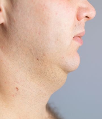 Fat-dissolving injection Fat-dissolving injection before and after pictures in Montreal