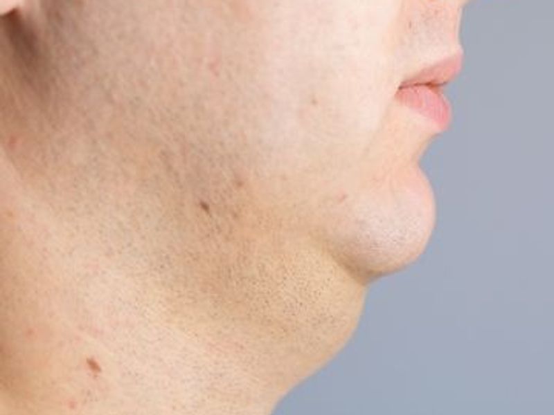 Fat-dissolving injection Fat-dissolving injection before and after pictures in Montreal