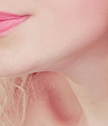 Fat-dissolving injection double chin treatment in Montreal after picture