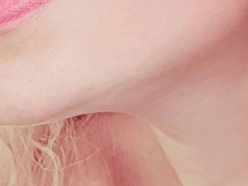 Fat-dissolving injection double chin treatment in Montreal after picture
