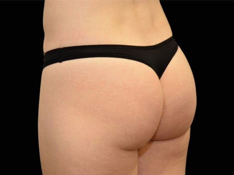 Butt lift After Emsculpt NEO Body Contouring fat removal therapy in Montreal