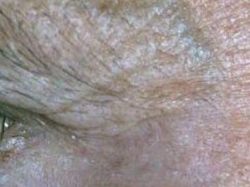 Before Fotona Laser Skin Treatment for eye wrinkles - Montreal
