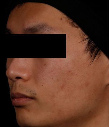 After AviClear laser acne removal treatment in Montreal