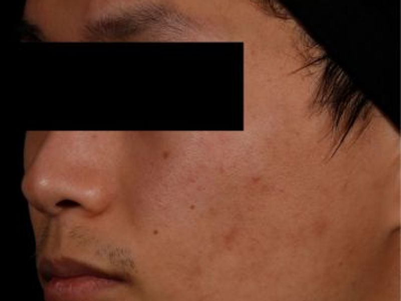 After AviClear laser acne removal treatment in Montreal