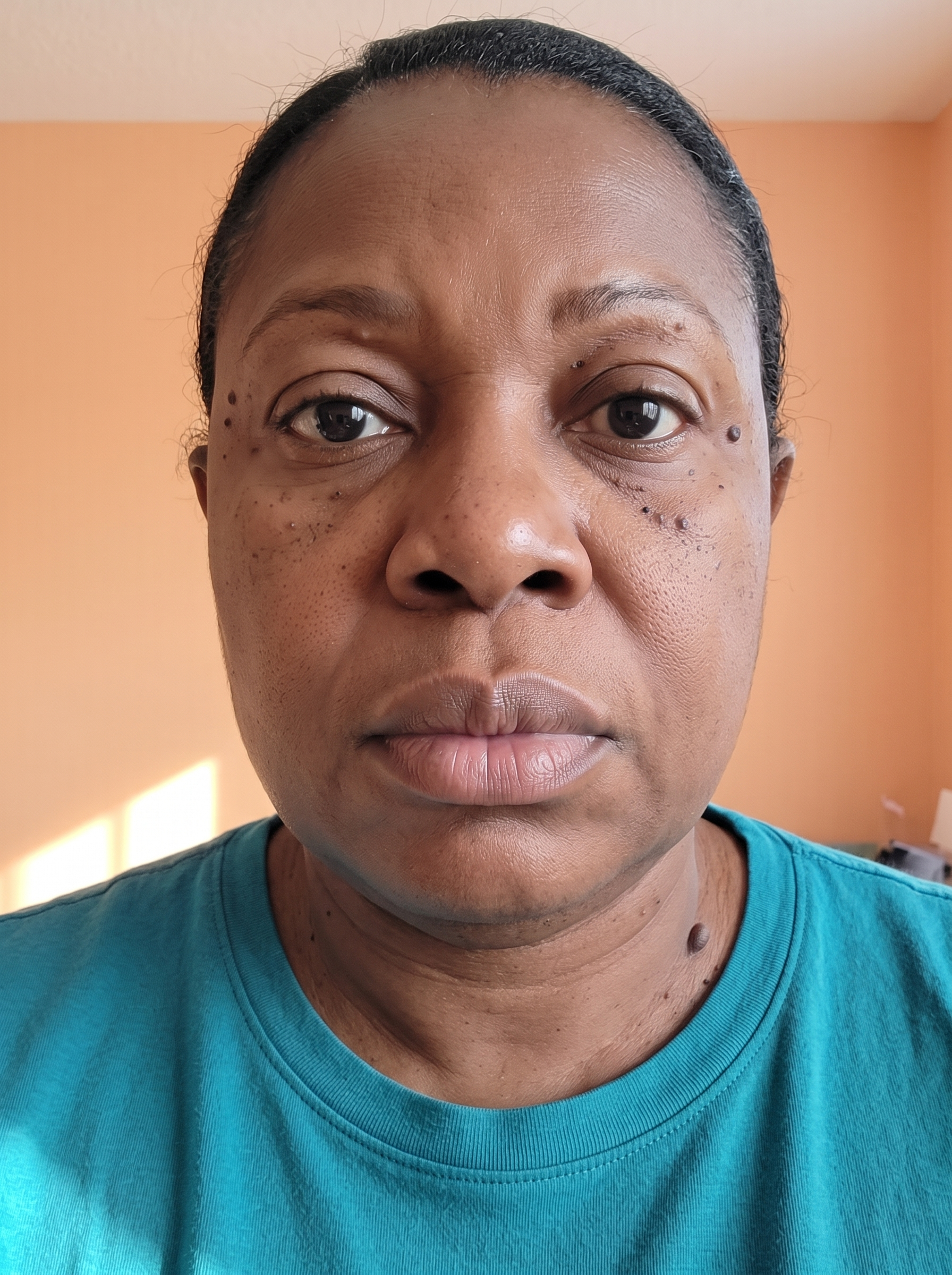 The same patient photographed at a later visit, from the same angle and under the same lighting.