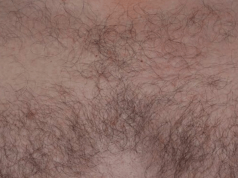 Chest laser hair removal before Excel HR treatment in Montreal