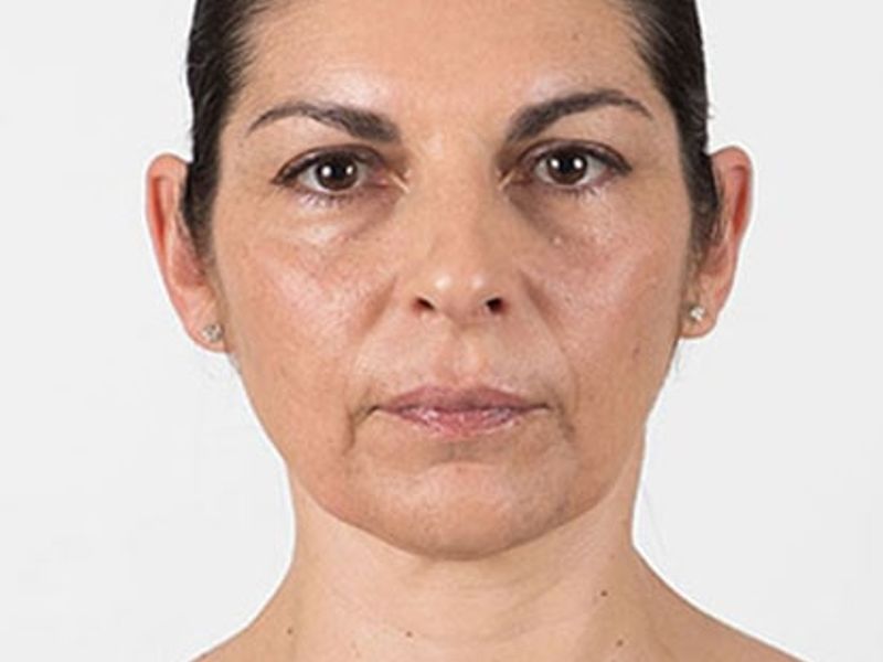 Before Aesthetic Hyaluronic acid dermal fillers injectables in Montreal