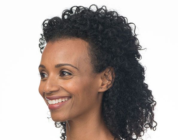 Before Aesthetic Wrinkle relaxer Treatments for crows feet in Montreal