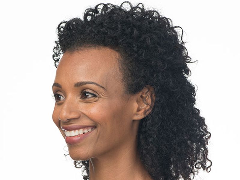 Before Aesthetic Wrinkle relaxer Treatments for crows feet in Montreal