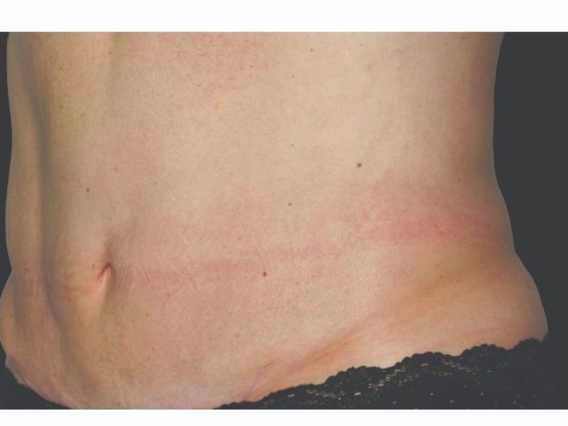 Stubborn Belly fat After CoolSculpting Body Contouring fat loss Treatment in Montreal