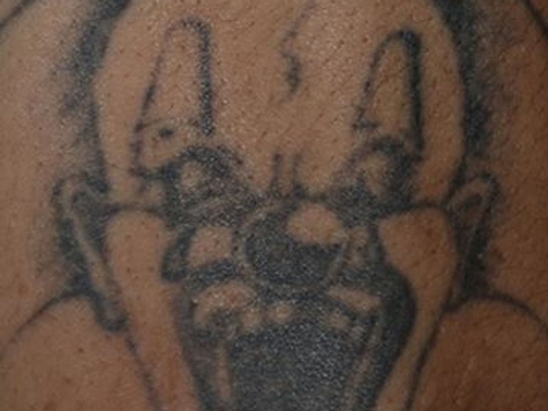 Before CUTERA Enlighten Tatto Removal Montreal