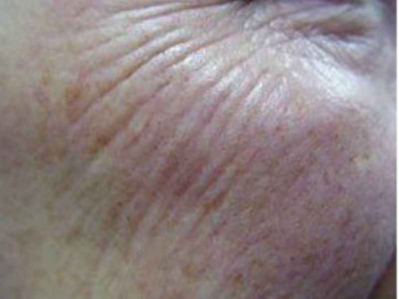 Before Fotona Laser Skin Treatment for wrinkle resurfacing - Montreal