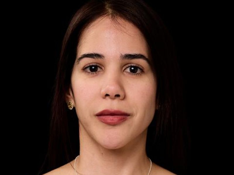 Before picture: triLift maintenance treatment in Montreal on young patient