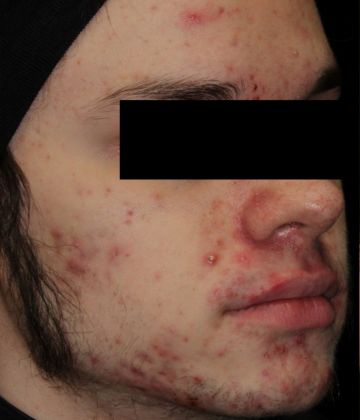 Before laser acne removal treatment in Montreal
