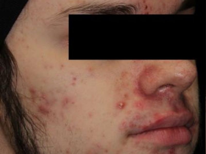 Before laser acne removal treatment in Montreal