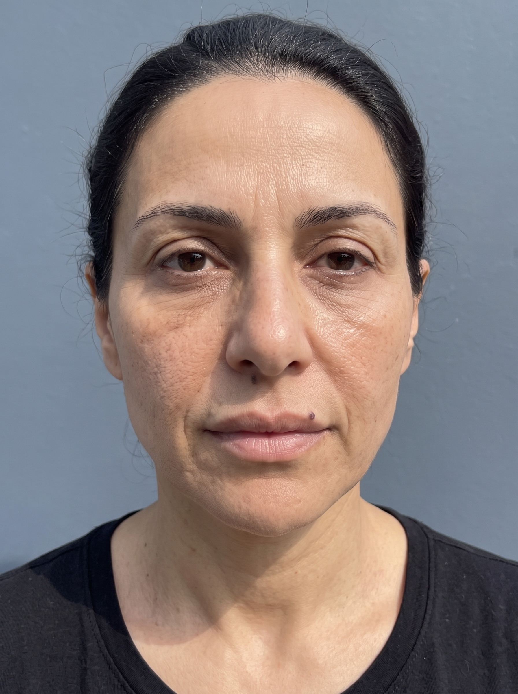 The same patient photographed at a later visit, from the same angle and under the same lighting.