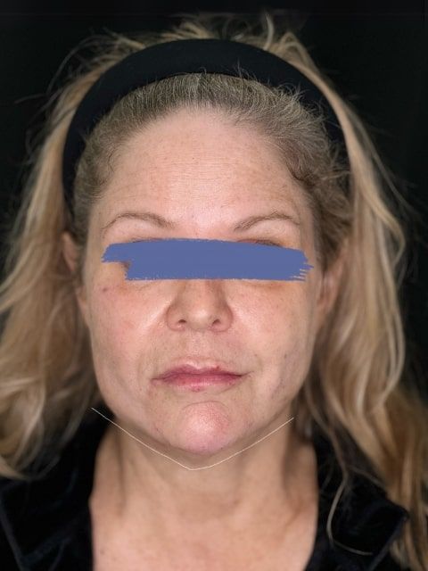 After Female Jawline PDO thread lift procedure at our Montreal, Quebec aesthetic clinic (frontal view)