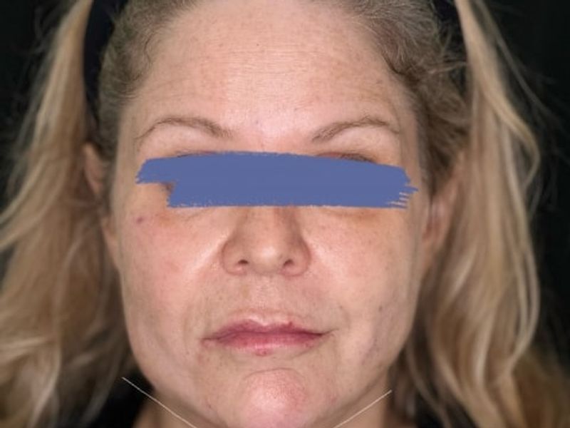 After Female Jawline PDO thread lift procedure at our Montreal, Quebec aesthetic clinic (frontal view)