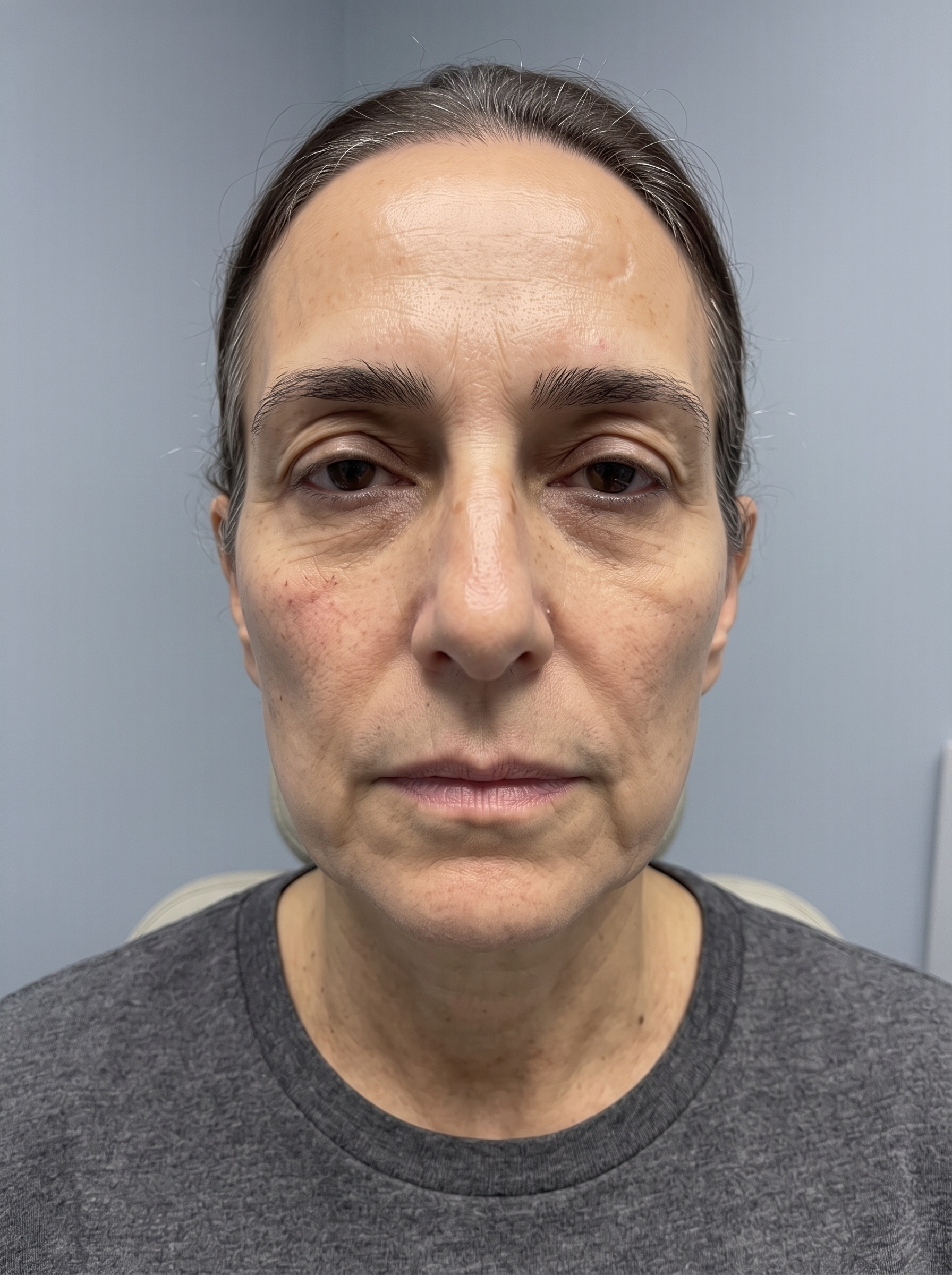 The same patient photographed at a later visit, from the same angle and under the same lighting.