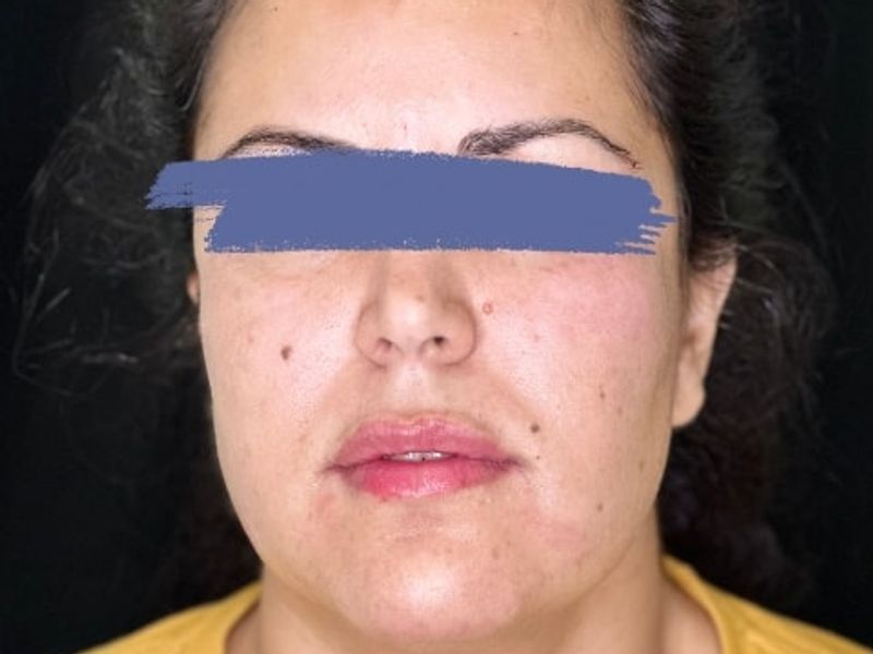 After Female Lip Fillers procedure at our Montreal aesthetic clinic