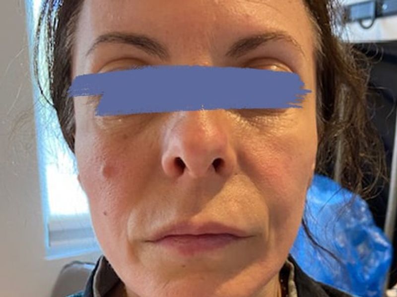 After Female jowls lift procedure with PDO threads at our Montreal, Quebec aesthetic clinic