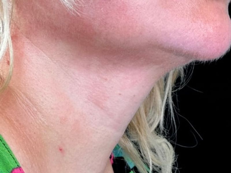 Before Female Neck Lines Dermal Fillers procedure at our Montreal aesthetic clinic