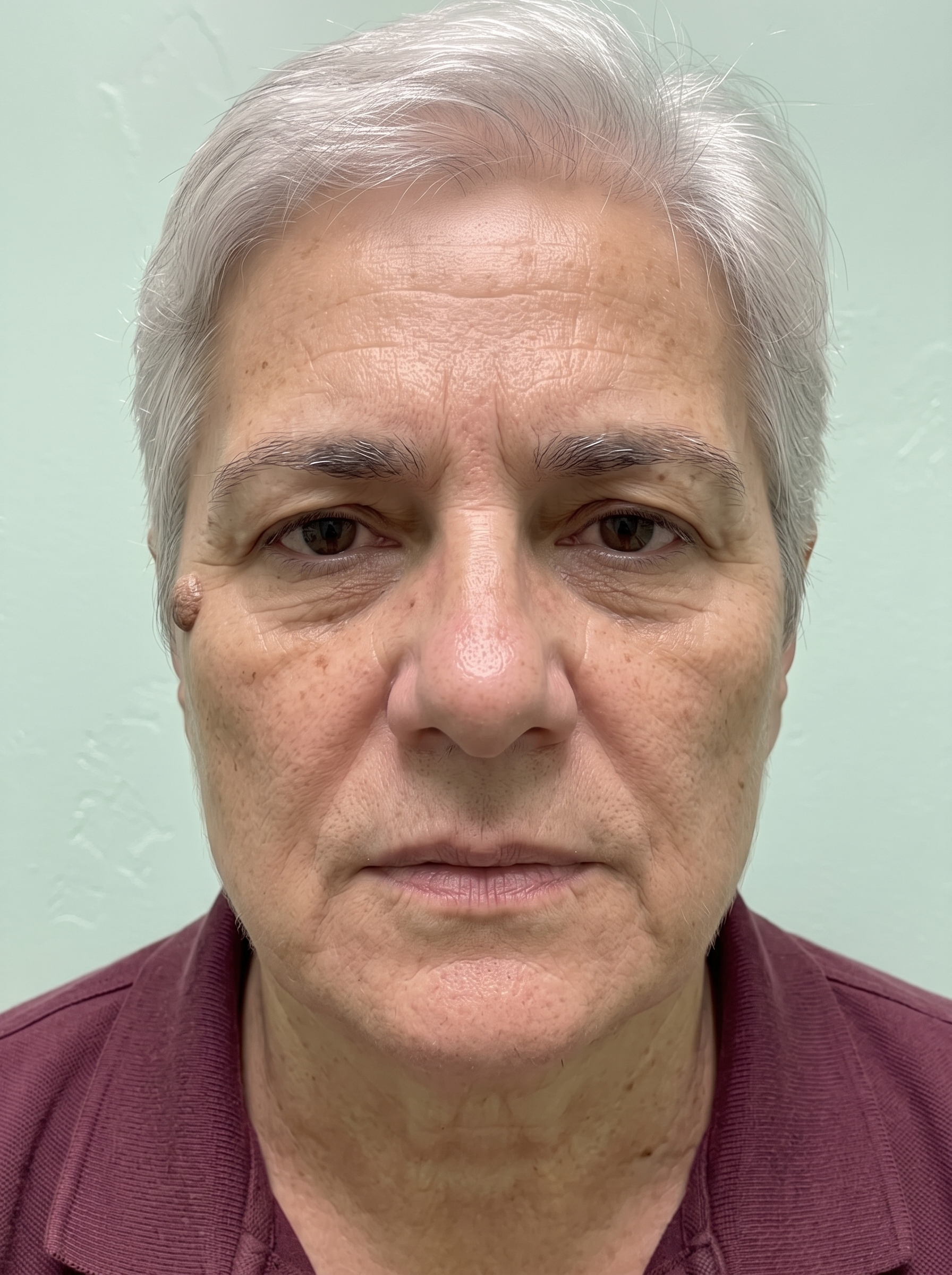The same patient photographed at a later visit, from the same angle and under the same lighting.
