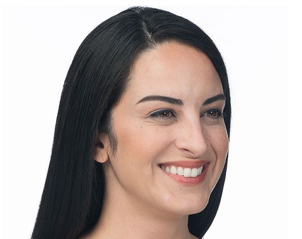 After Aesthetic Wrinkle relaxer Treatments for crows feet in Montreal