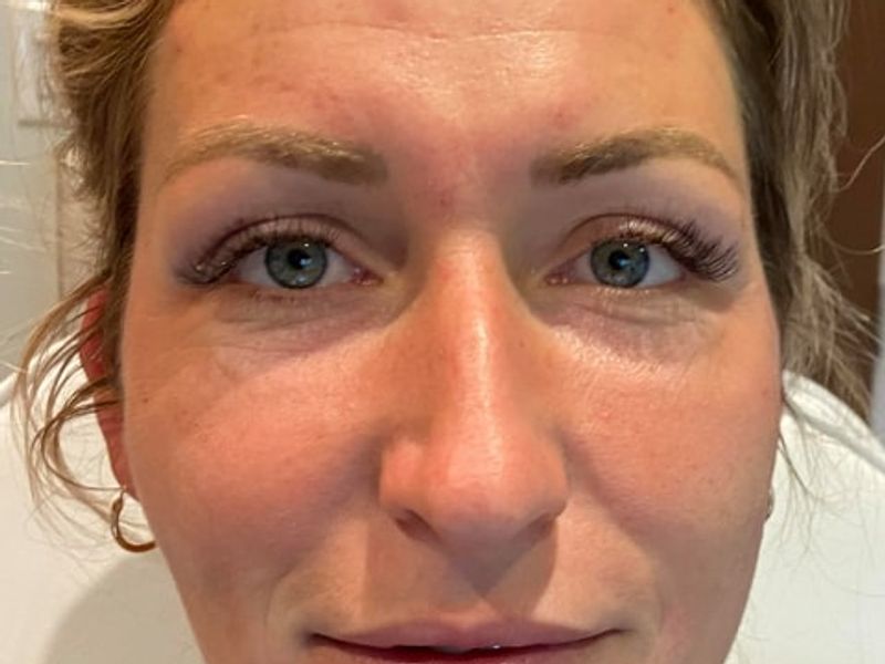 Droopy eyes and jaw before PDO thread lift procedure at our Montreal, Quebec aesthetic clinic
