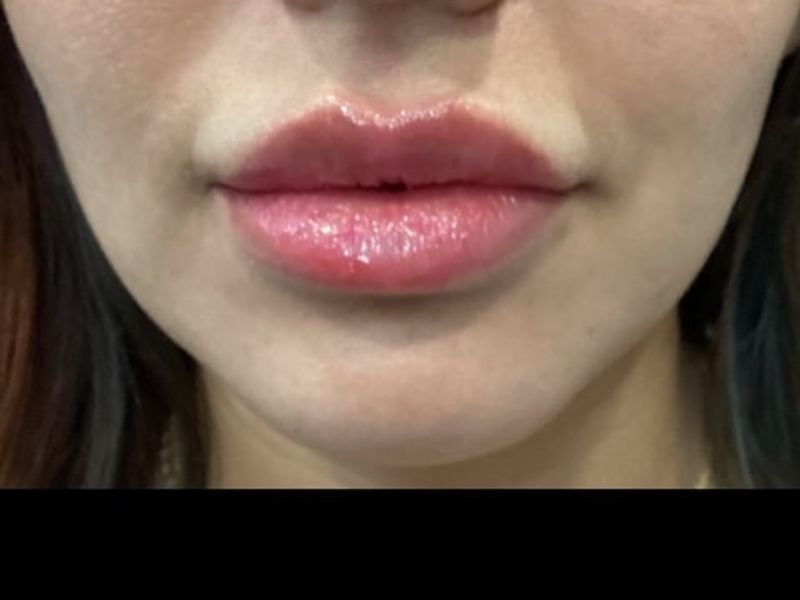 After Female Lip Fillers procedure at our Montreal aesthetic clinic
