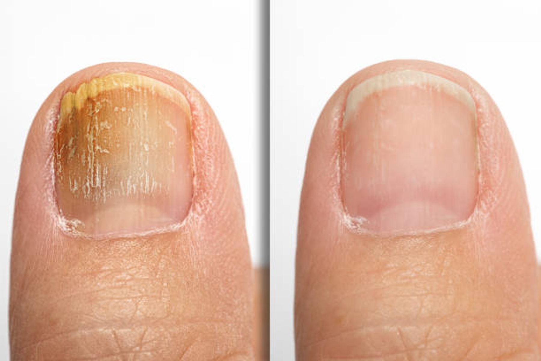 Tackling Toe Fungus: Your Guide to Healthy, Beautiful Feet at Ideal Body Clinic