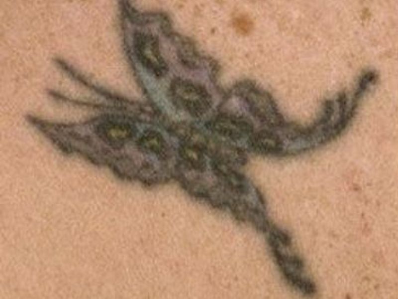 Before Fotona Laser Skin tattoo removal - Montreal