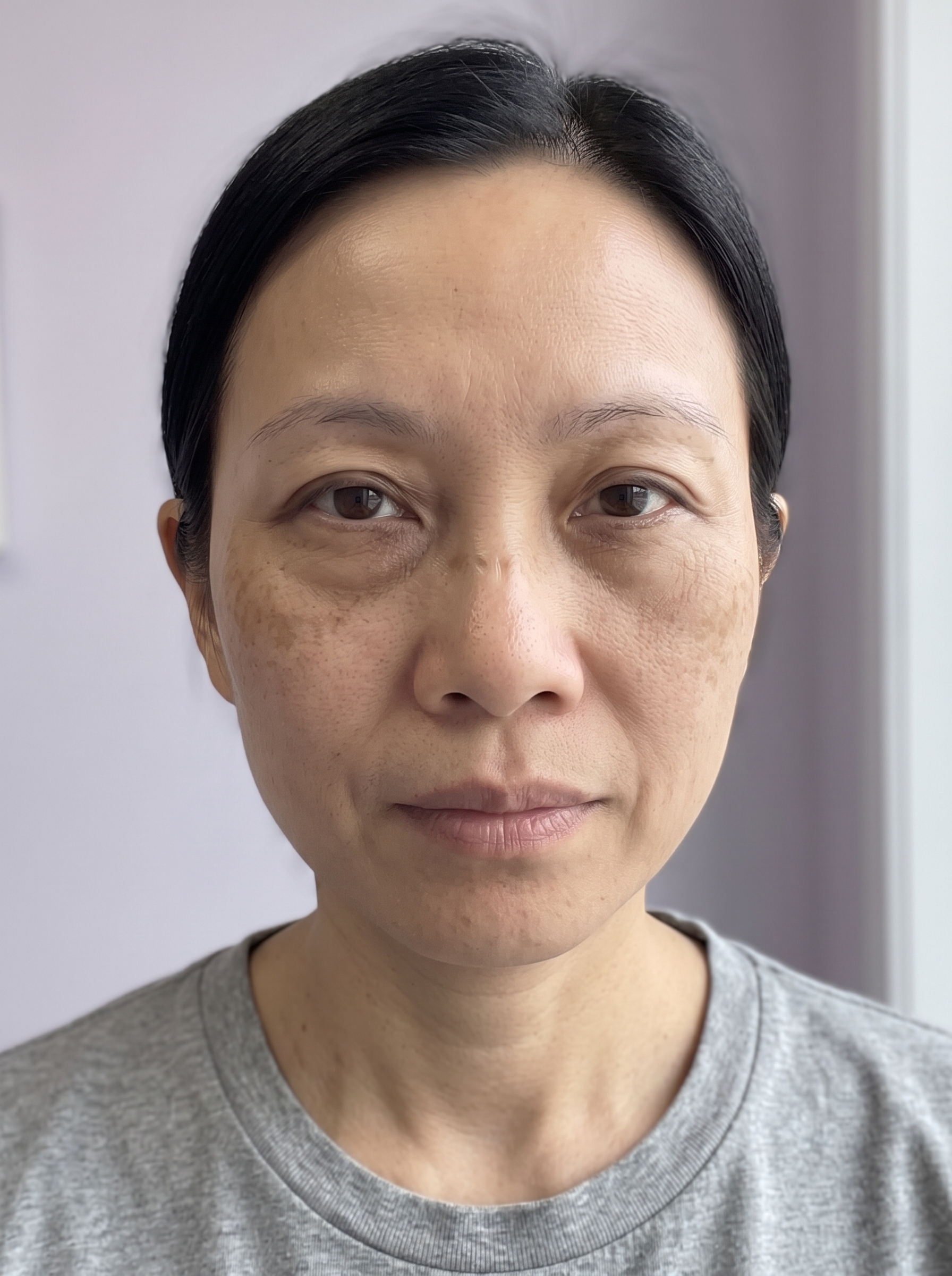The same patient photographed at a later visit, from the same angle and under the same lighting.
