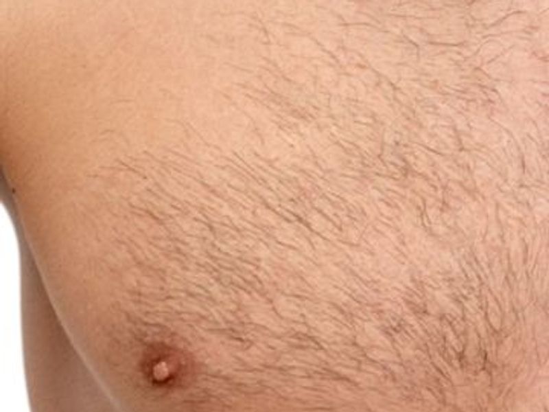 Chest before picture laser hair removal treatment ideal body clinic in Montreal