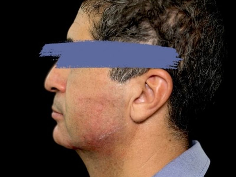 After Male Jawline Fillers procedure at our Montreal aesthetic clinic