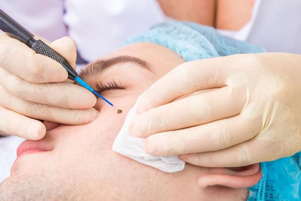 Clear, Even Skin Starts Here: Remove Moles, Skin Tags, Brown Spots & Melasma at Ideal Body Clinic