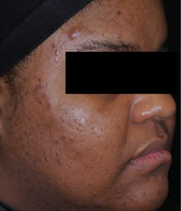 After AviClear laser acne removal treatment, Ideal Body Clinic, Montreal