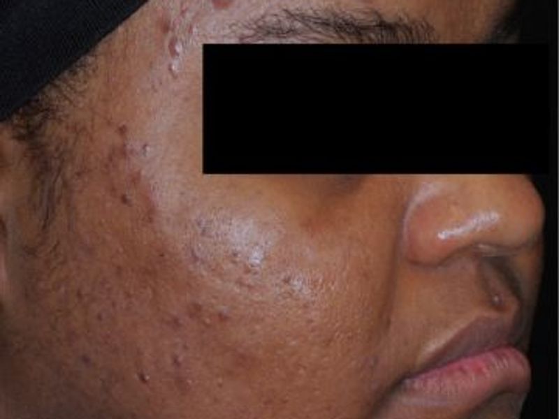 After AviClear laser acne removal treatment, Ideal Body Clinic, Montreal