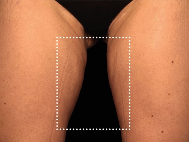Thigh gap After Emsculpt NEO Body Contouring fat removal therapy in Montreal
