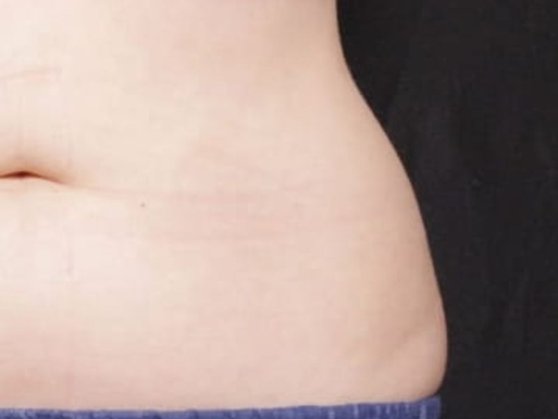 After love handles picture Venus Bliss Max Contouring treatment