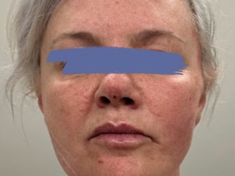 Before Female PDO thread nose lift procedure at our Montreal aesthetic clinic