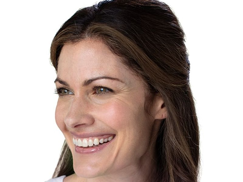 Before Aesthetic Wrinkle relaxer Treatments for crows feet in Montreal