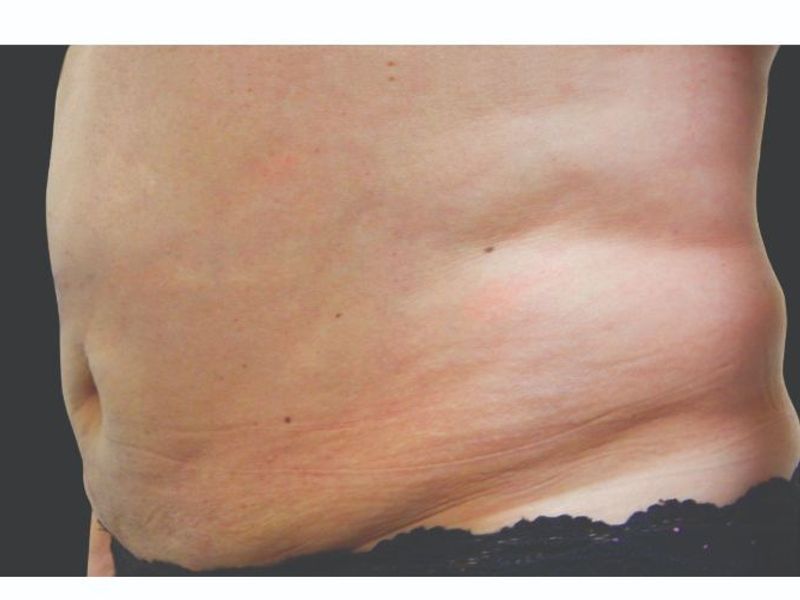 Stubborn Belly fat Before CoolSculpting Body Contouring fat loss Treatment in Montreal