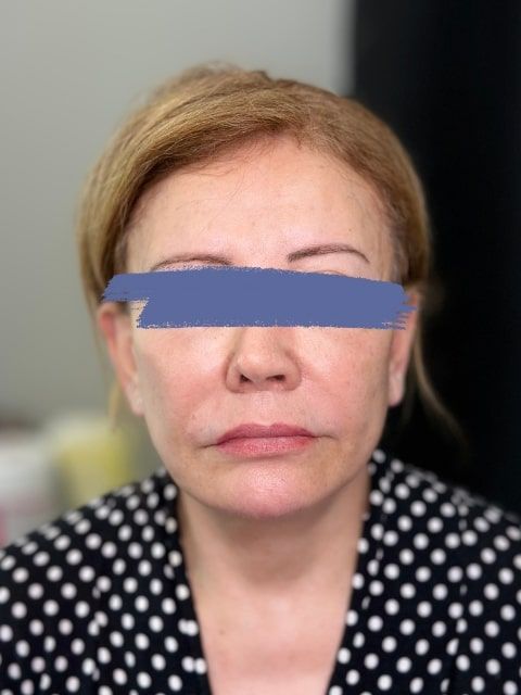 After Female Collagen-stimulating filler (CaHA) Jawline Fillers procedure at our Montreal aesthetic clinic