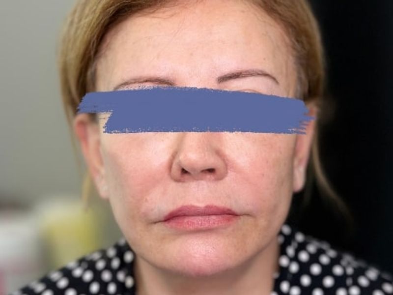 After Female Collagen-stimulating filler (CaHA) Jawline Fillers procedure at our Montreal aesthetic clinic
