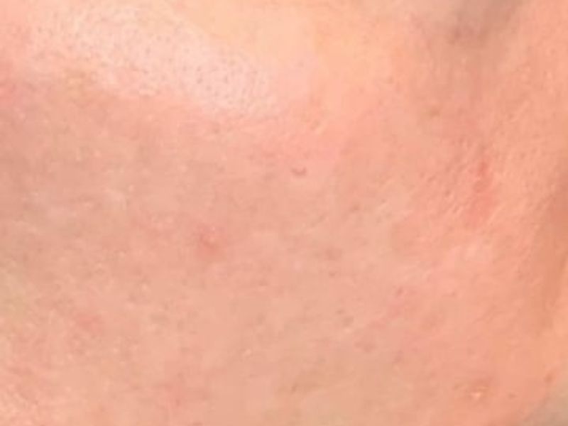 After Secret Pro by Cutera for skin damage - Montreal