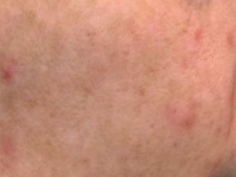 Before Secret Pro by Cutera for skin damage - Montreal