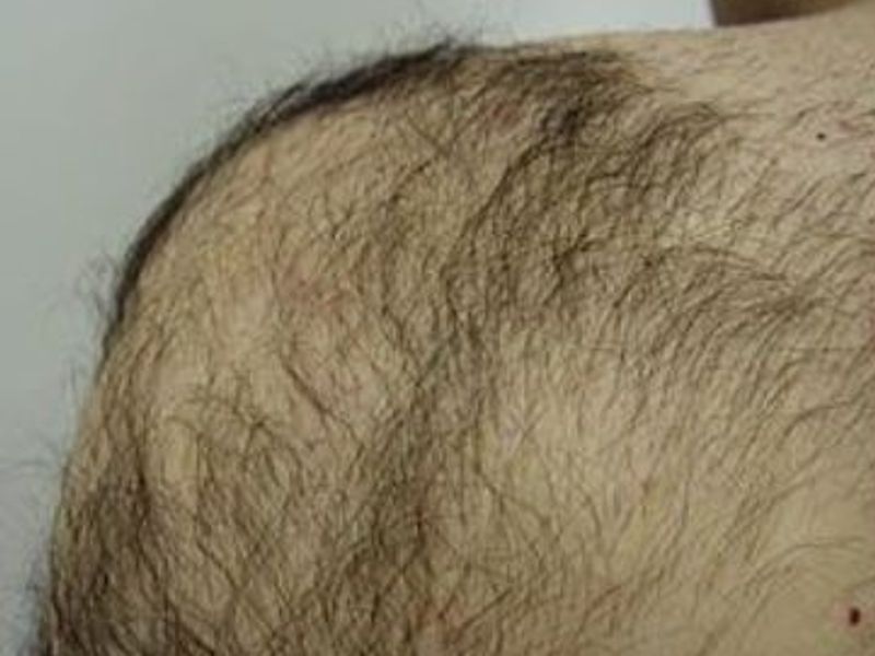 Before Fotona Laser Skin Treatment for body hair removal - Montreal