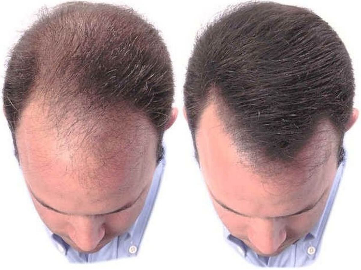 LT hair removal